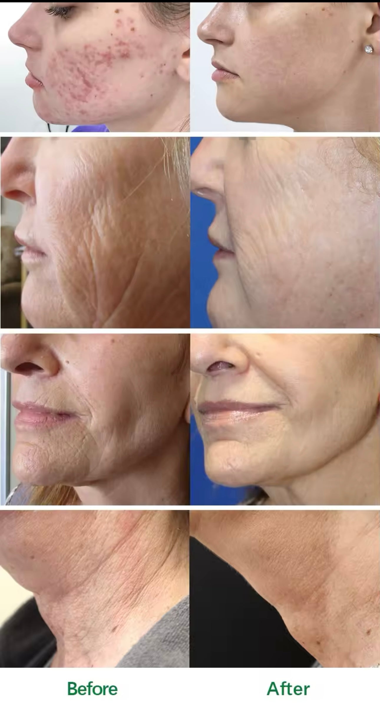 RF Micro Needling Gold Radiofrequenz Mikrokristall Microneedling